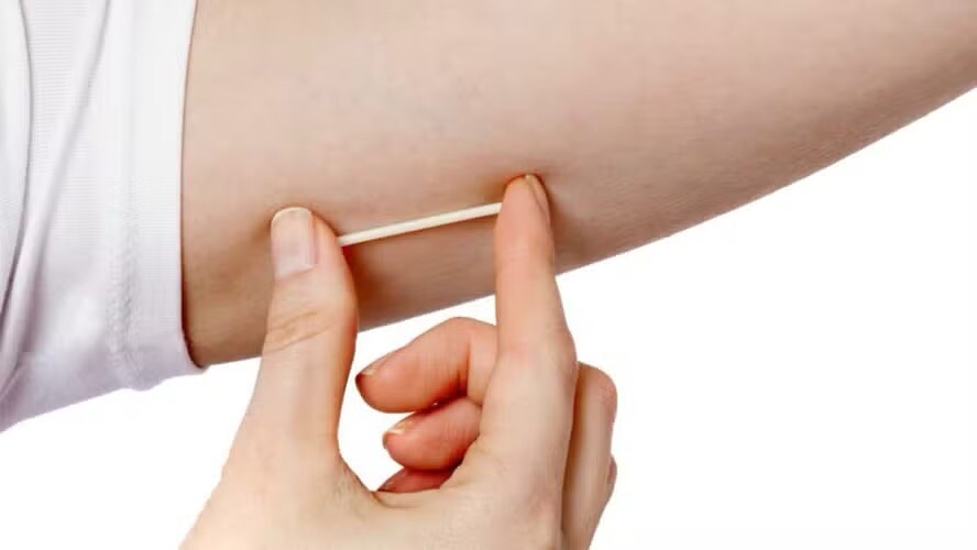 chip-da-beleza-anvisa-proibe-hormonios-implantaveis-manipulados-e-alerta-sobre-riscos-a-saude